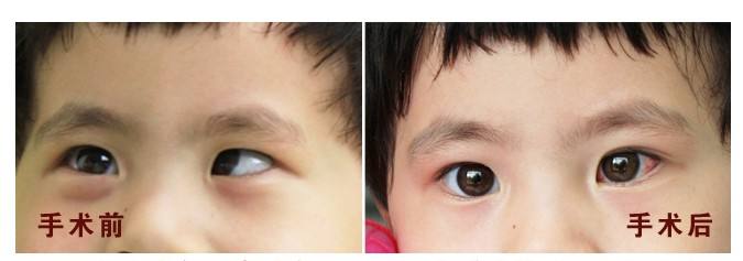 孩子斜视术后多久能恢复？有哪些注意事项？